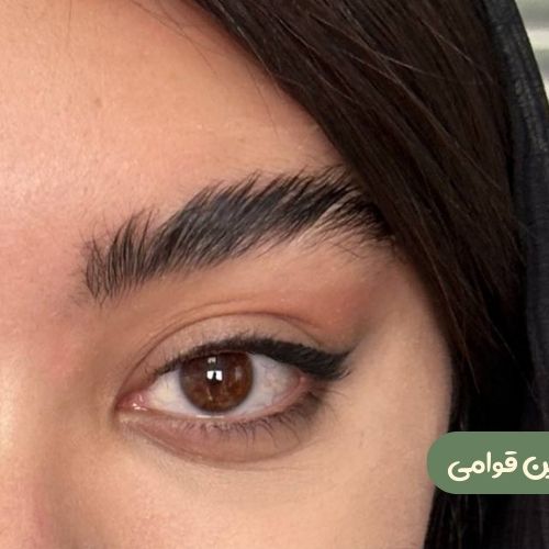 بعد از لیفت شقیقه