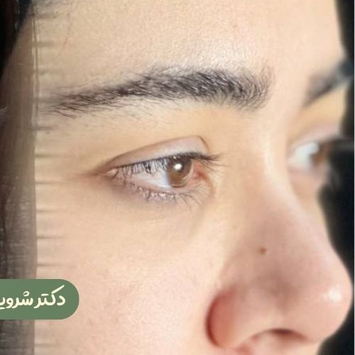قبل از لیفت شقیقه
