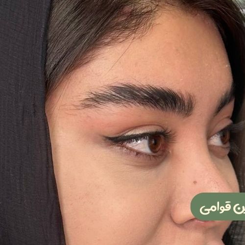بعد از لیفت شقیقه