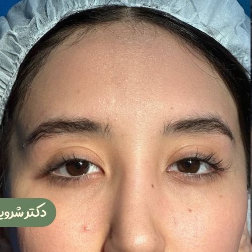 قبل از لیفت شقیقه