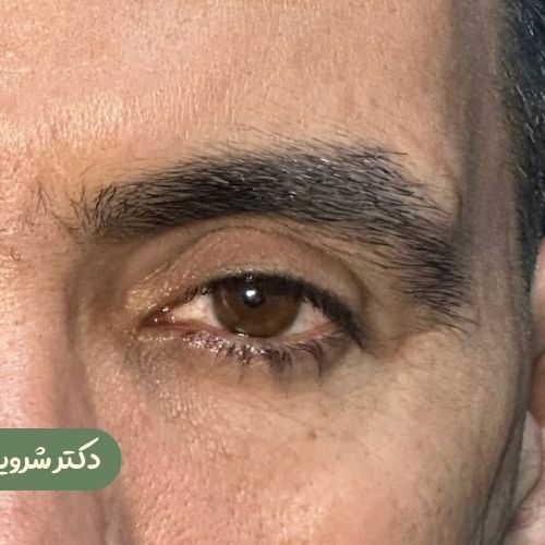 قبل از لیفت شقیقه