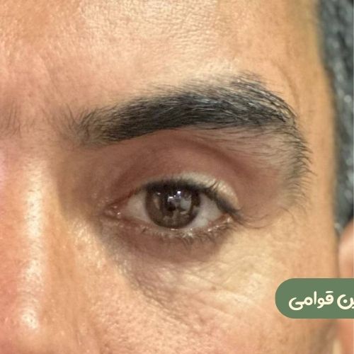 بعد از لیفت شقیقه