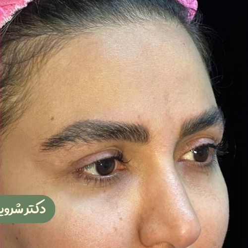 قبل از لیفت شقیقه
