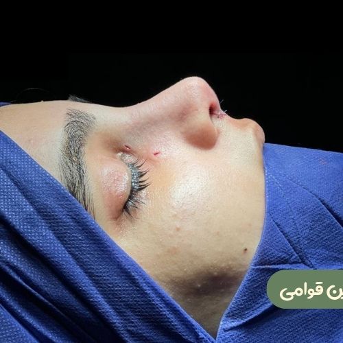 بعد از رینوپلاستی