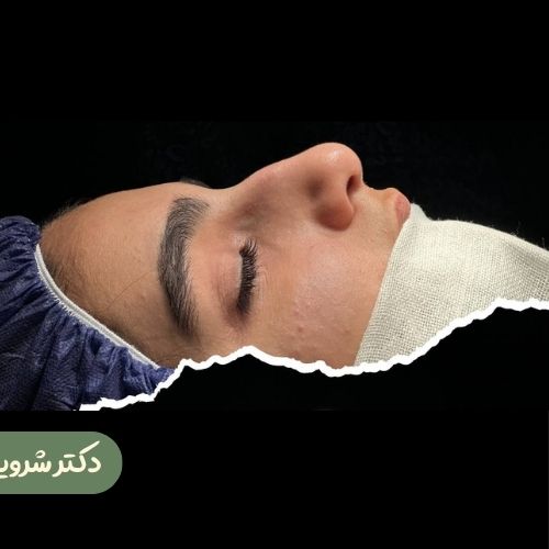 قبل از رینوپلاستی