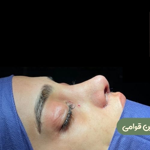 بعد از رینوپلاستی