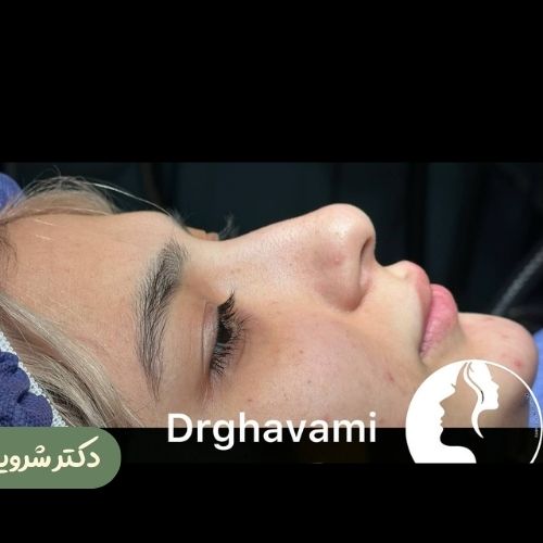 قبل از رینوپلاستی