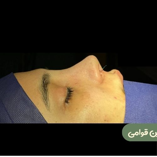 بعد از رینوپلاستی