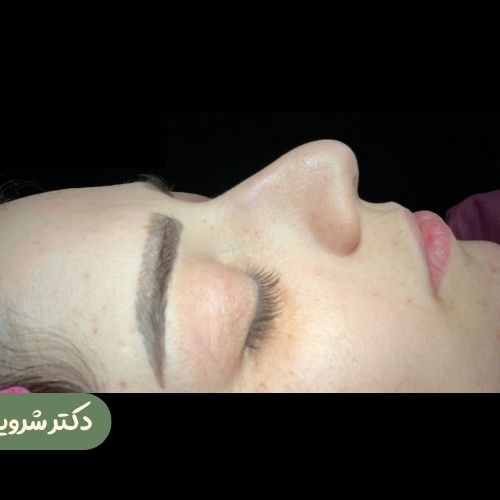 قبل از رینوپلاستی