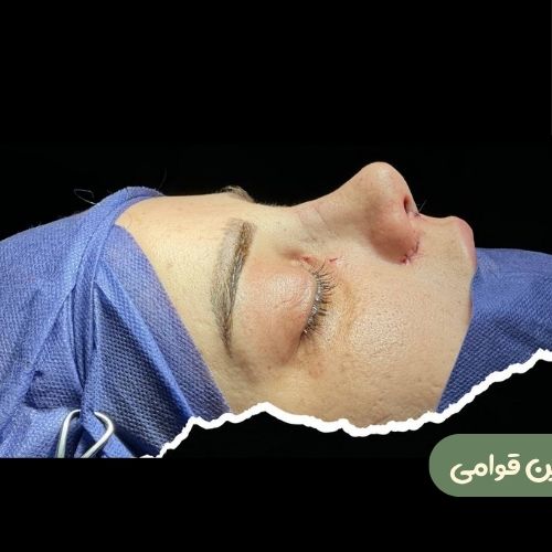 بعد از رینوپلاستی