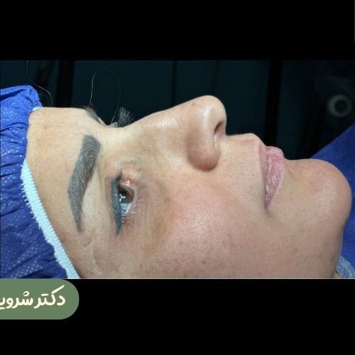 قبل از رینوپلاستی