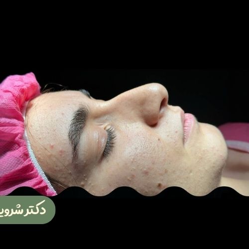 قبل از رینوپلاستی