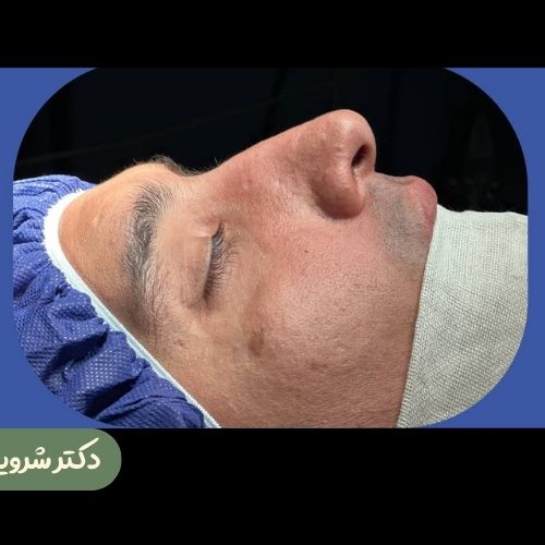 قبل از رینوپلاستی