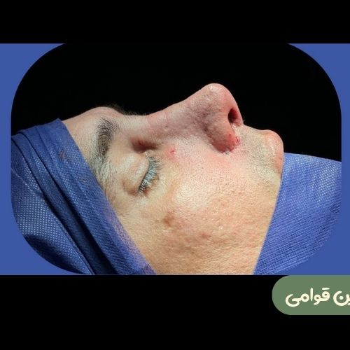بعد از رینوپلاستی