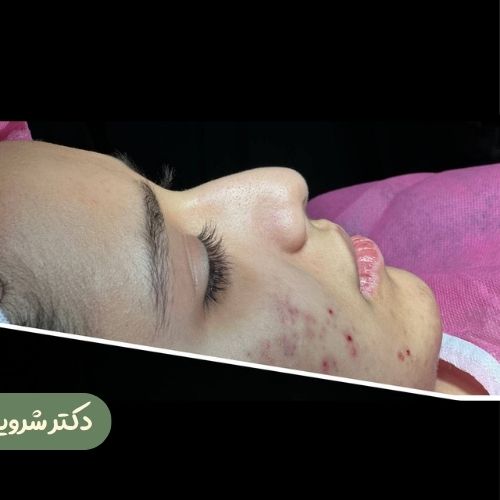 قبل از رینوپلاستی