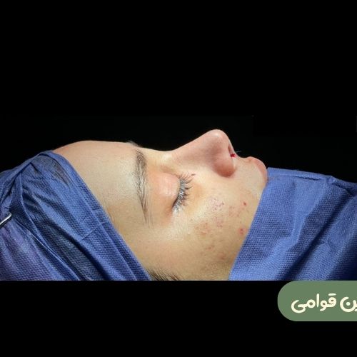 بعد از رینوپلاستی