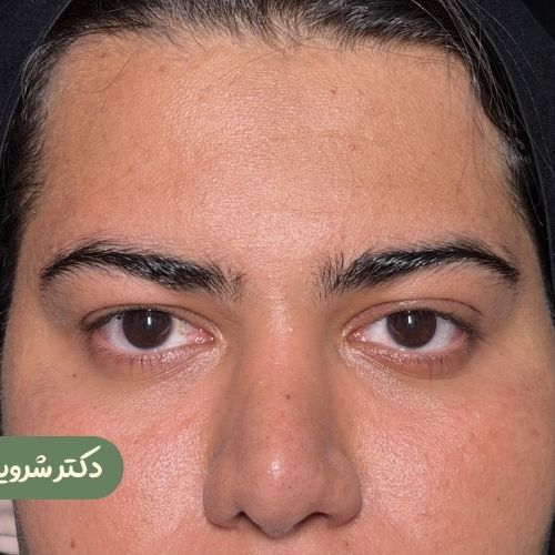 قبل از لیفت شقیقه
