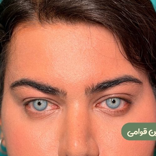 بعد از لیفت شقیقه