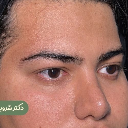 قبل از لیفت شقیقه