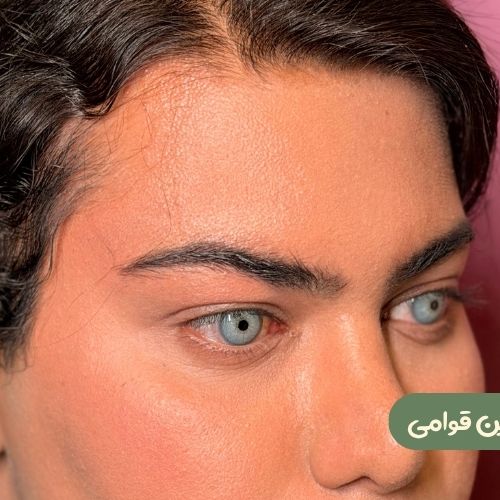 بعد از لیفت شقیقه