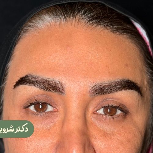 قبل از لیفت شقیقه