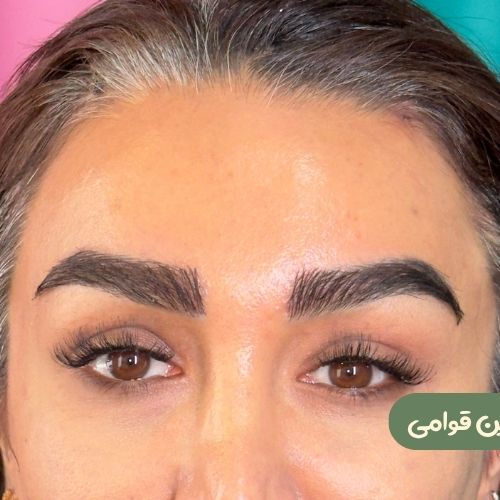 بعد از لیفت شقیقه