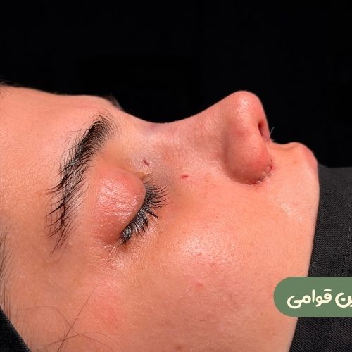بعد از رینوپلاستی ترمیمی