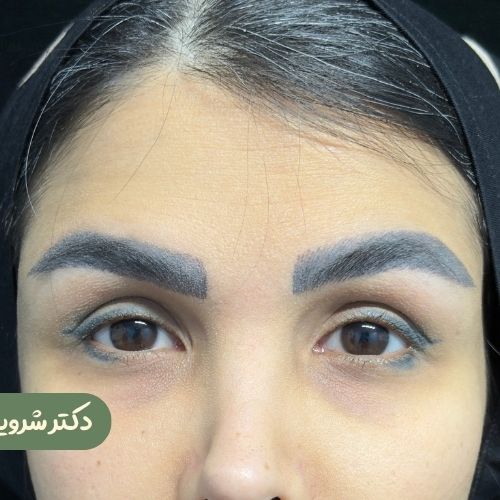 قبل از لیفت شقیقه