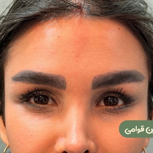 بعد از لیفت شقیقه