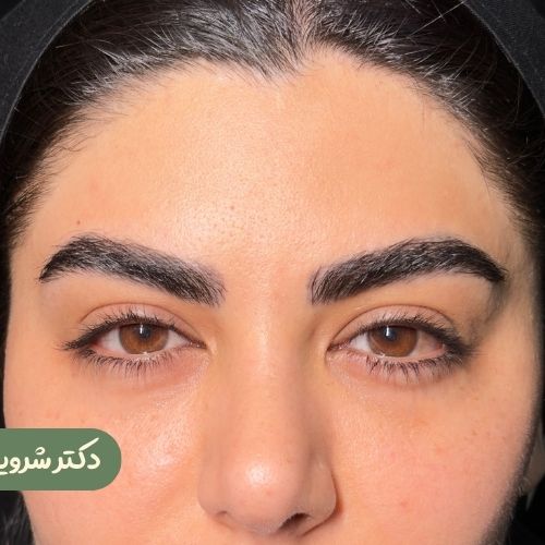 قبل از لیفت شقیقه