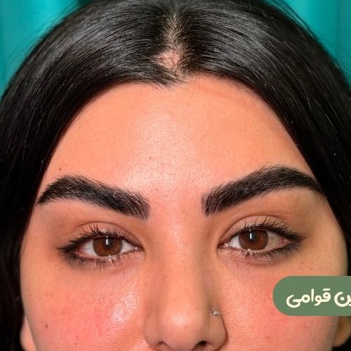 بعد از لیفت شقیقه