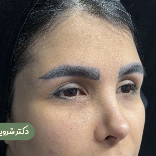 قبل از لیفت شقیقه