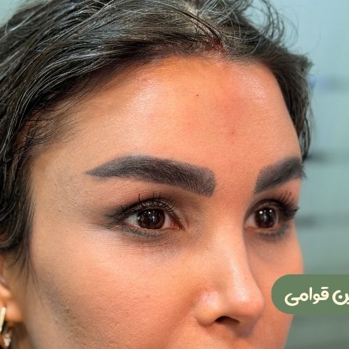 بعد از لیفت شقیقه