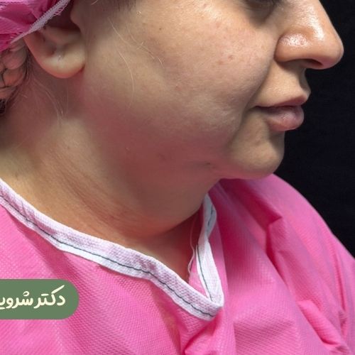 قبل از ژنیوپلاستی + ساکشن غبغب