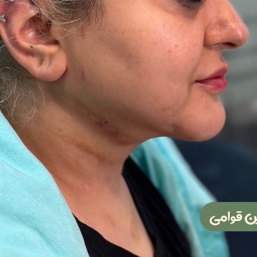 بعد از ژنیوپلاستی + ساکشن غبغب
