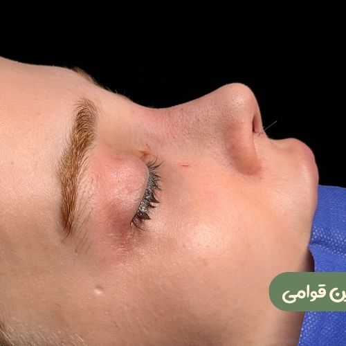بعد از رینوپلاستی