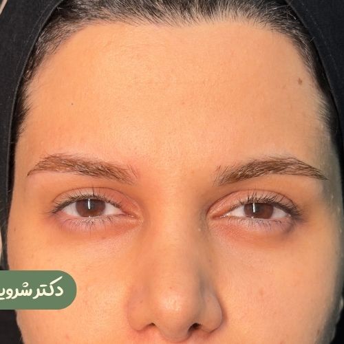 قبل از لیفت شقیقه