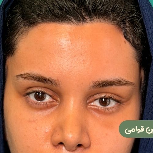 بعد از لیفت شقیقه