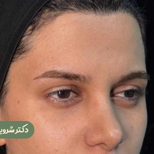 قبل از لیفت شقیقه