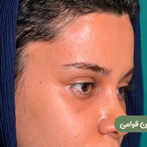 بعد از لیفت شقیقه