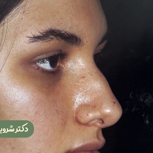 قبل از رینوپلاستی
