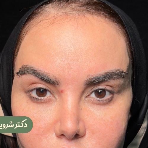 قبل از ترمیم لیفت شقیقه جراح دیگر