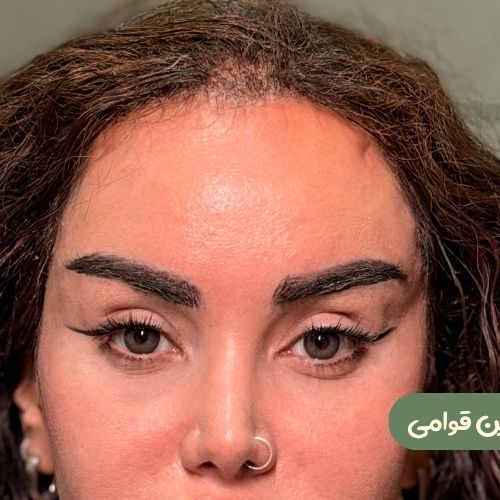 بعد از ترمیم لیفت شقیقه جراح دیگر