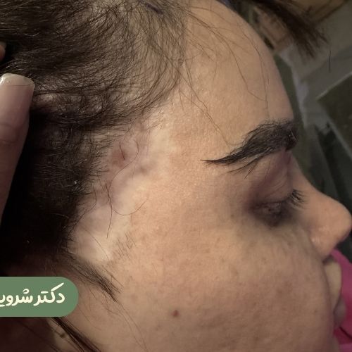 قبل از ترمیم لیفت شقیقه جراح دیگر