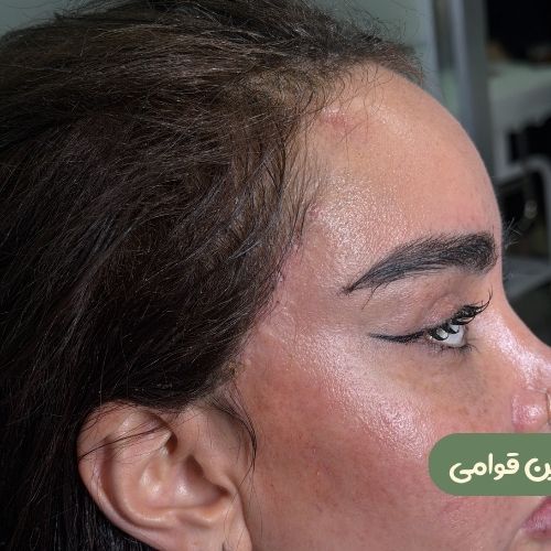 بعد از ترمیم لیفت شقیقه جراح دیگر
