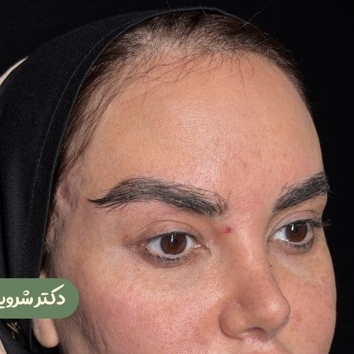 قبل از ترمیم لیفت شقیقه جراح دیگر