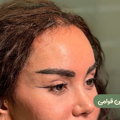 بعد از ترمیم لیفت شقیقه جراح دیگر