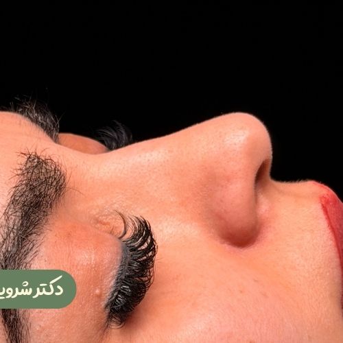 قبل از رینوپلاستی