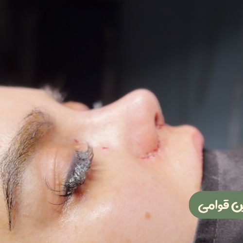 بعد از رینوپلاستی