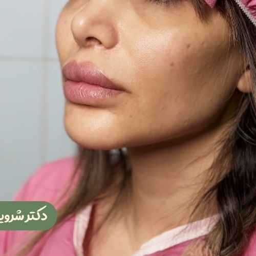 قبل از ژنیوپلاستی